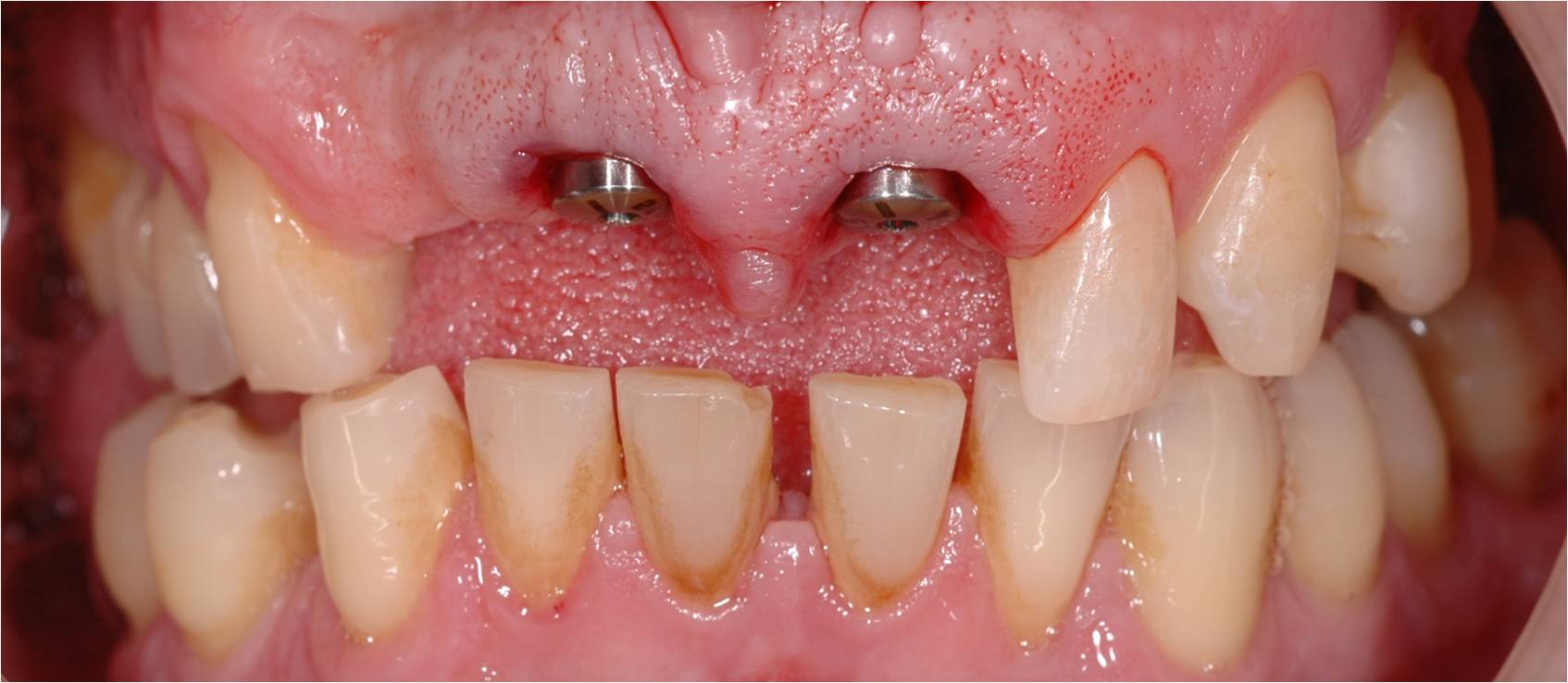 tand d.m.v. één implantaat tandarts Philippe Nuytens